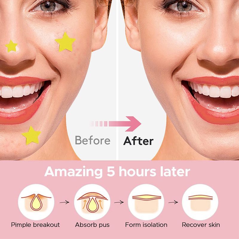 600 PCS/Set Star Pimple Patch  – Beauty Makeup Face recenzja i cena